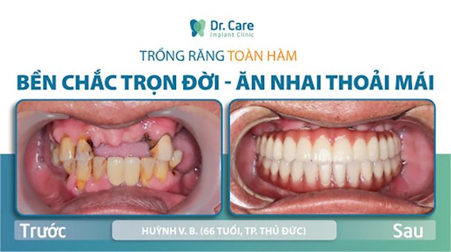 răng implant bị lung lay