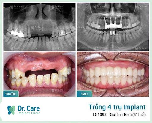 trồng răng giả cho người già