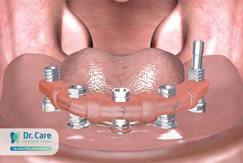 Bước 7: Thử độ chính xác của dấu Implant