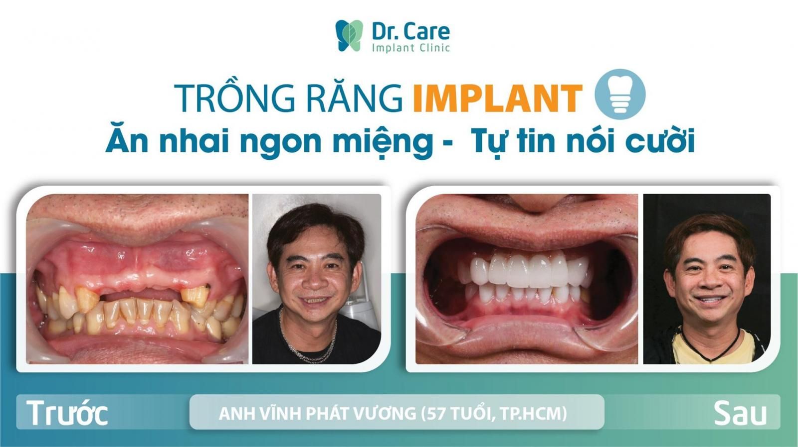 trồng răng implant toàn hàm