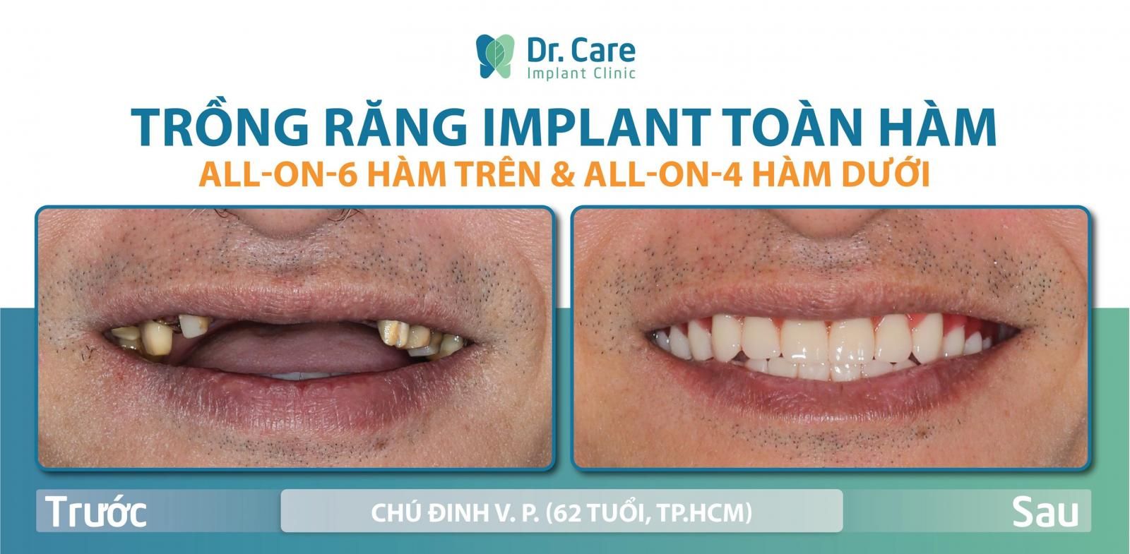 trồng răng implant toàn hàm