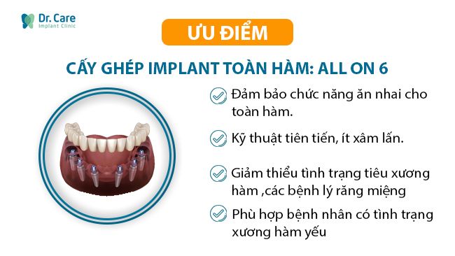 Ưu điểm cấy ghép Implant toàn hàm All On 6