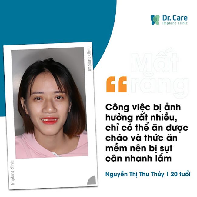 Mất răng bao lâu thì trồng răng giả được