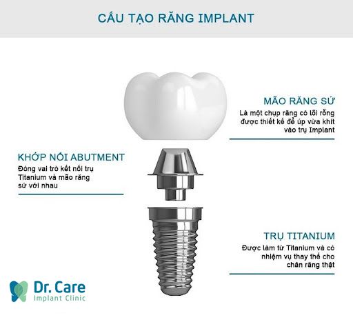 trụ implant bị vỡ