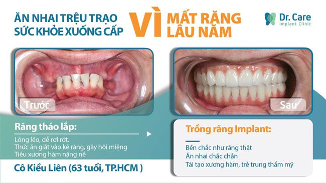 Cô Kiều Liên (63 tuổi, TP. HCM) ăn nhai trệu trạo, phải dùng lực nướu để nghiền thức ăn. Để chấm dứt nỗi đau đó cô đã lựa chọn trồng răng Implant