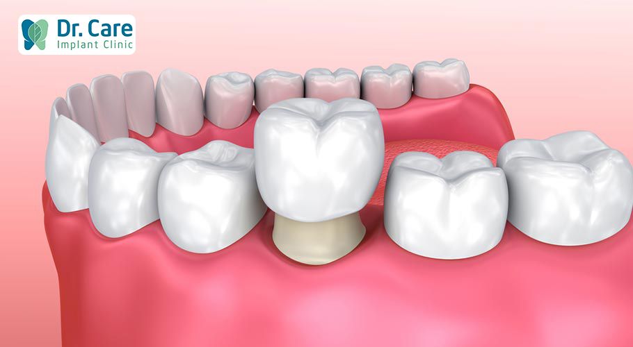 Bọc răng sứ là gì? Các trường hợp nên bọc răng sứ