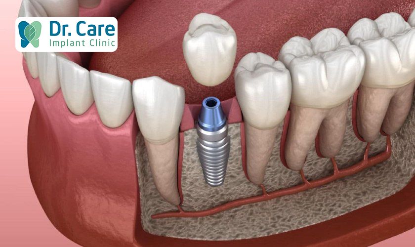 Nên trồng Implant khi mất răng hay tiến hành bọc răng sứ?