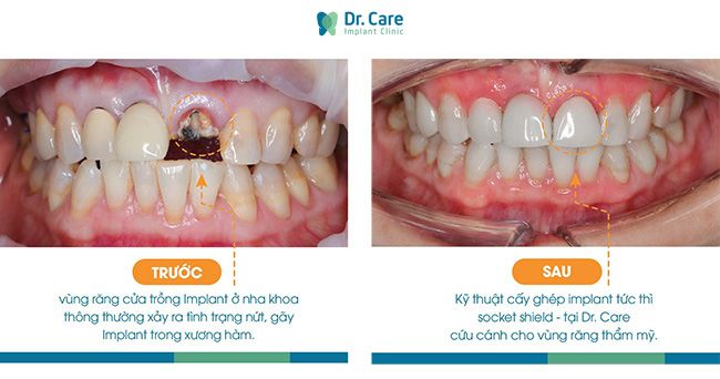 Khách hàng sử dụng dịch vụ trồng răng Implant tức thì