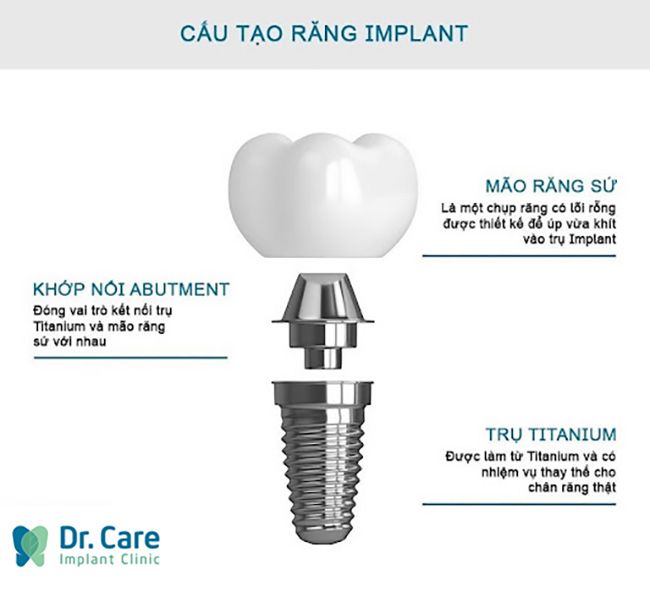 kỹ thuật cấy ghép implant là gì