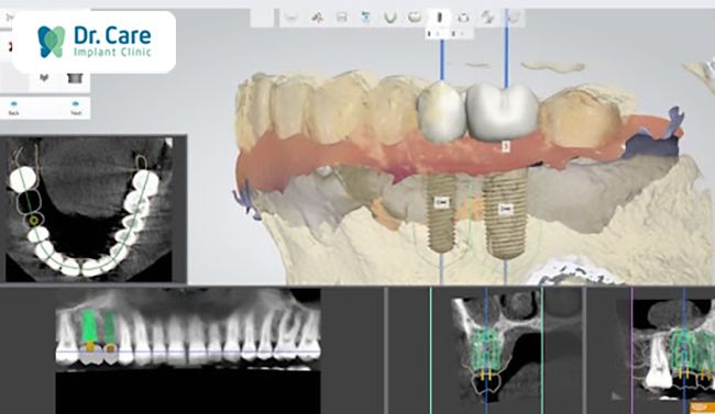 abutment implant là gì