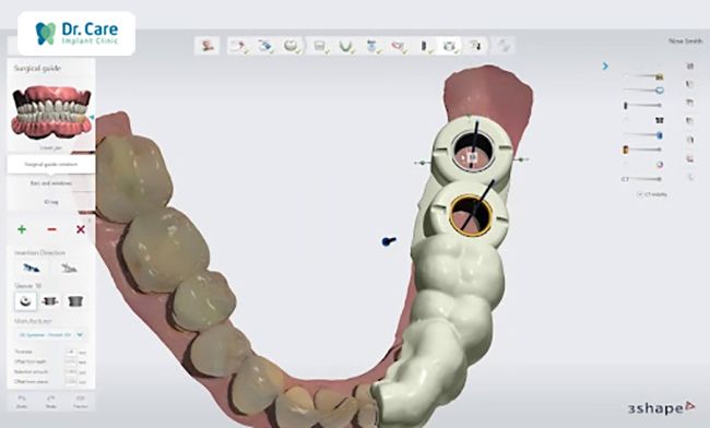 abutment implant là gì