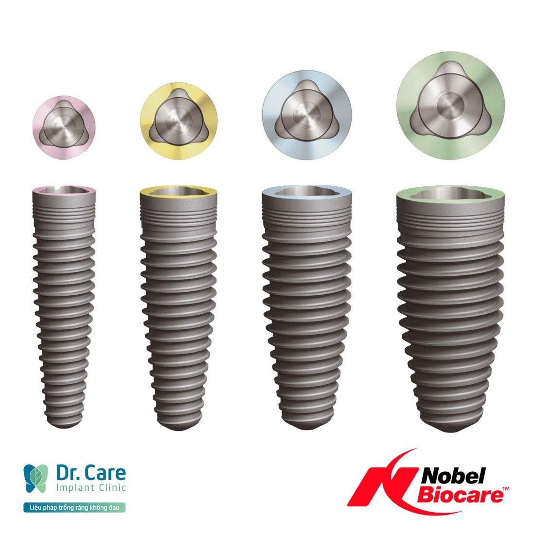 cách trồng răng cửa bằng cấy ghép Implant