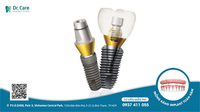 Ưu điểm của trụ Implant Dentium Hàn Quốc