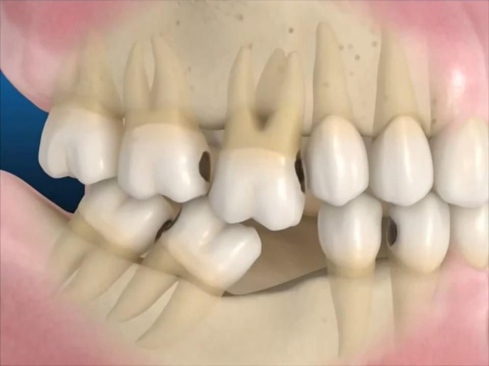 Các răng xung quanh nghiêng ngả, xô lệch, răng đối diện có hiện tượng thòng xuống