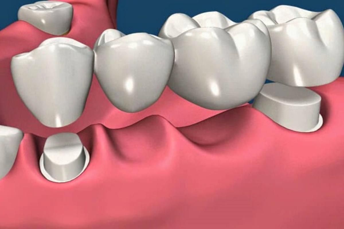 Mão răng sứ được chụp lên hai trụ cầu đã được mài mòn