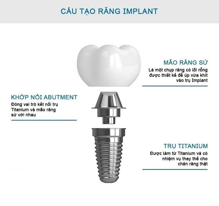 Cấu tạo của một chiếc răng Implant