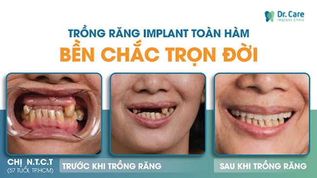 Trồng răng implant chính là phương pháp phục hồi răng tiên tiến nhất để giúp khách hàng có thể ăn nhai thoải mái