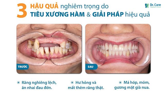 Mất răng lâu ngày mà không trồng răng Implant có thể dẫn đến những hậu quả nghiêm trọng