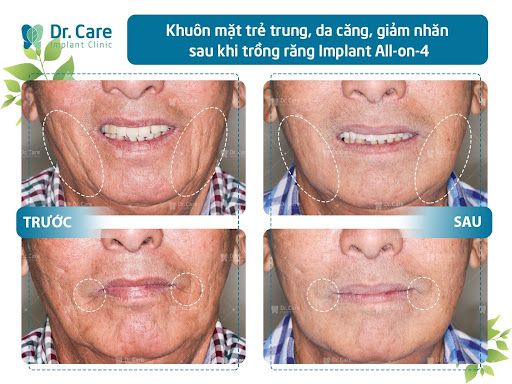 kỹ thuật cấy ghép implant