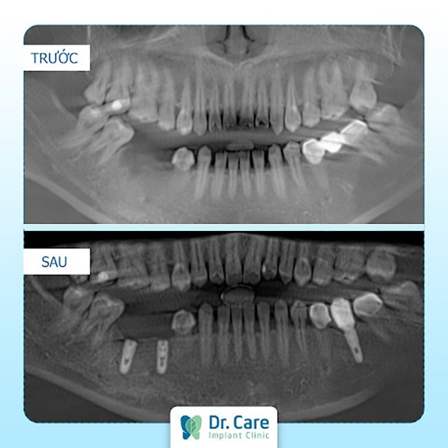 kỹ thuật cấy ghép implant