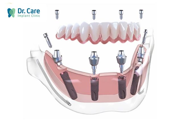 Kỹ thuật Implant toàn hàm All on 4 và All on 6