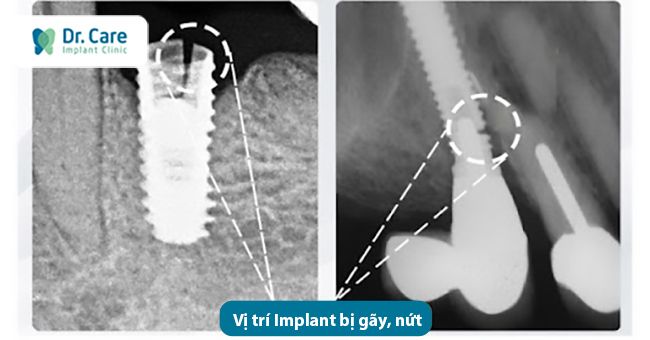 kỹ thuât cấy ghép implant