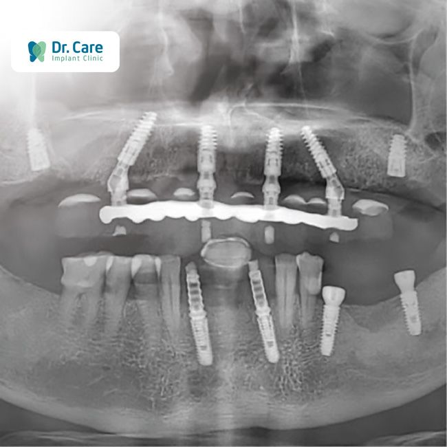 kỹ thuật cấy ghép implant