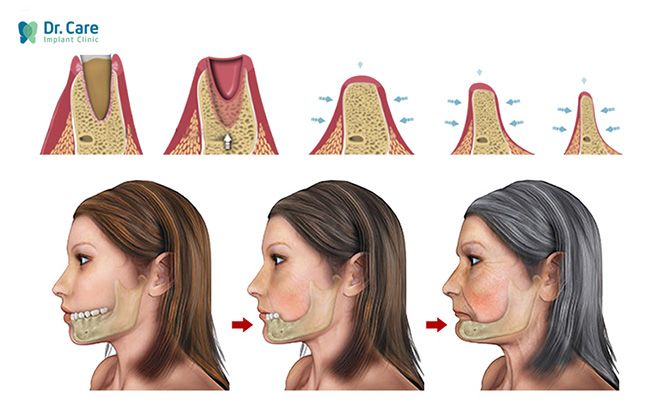 kỹ thuật cấy ghép implant