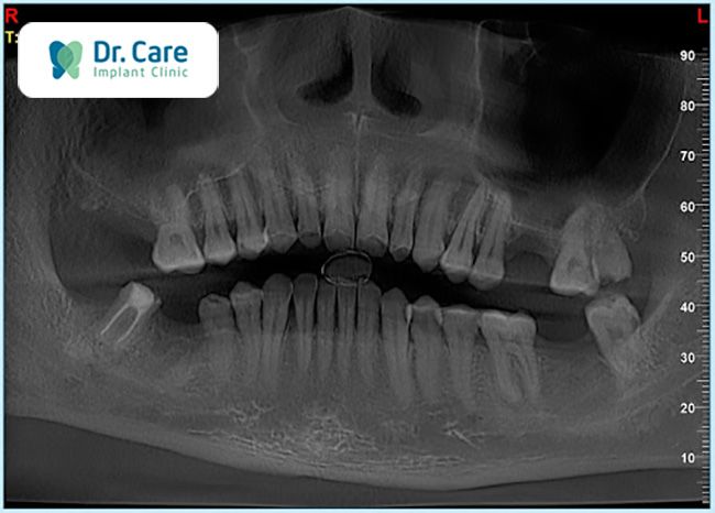 kỹ thuật cấy ghép implant