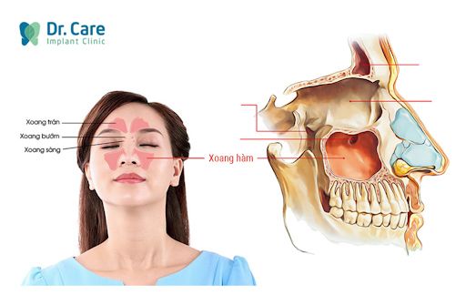 kỹ thuật cấy ghép implant