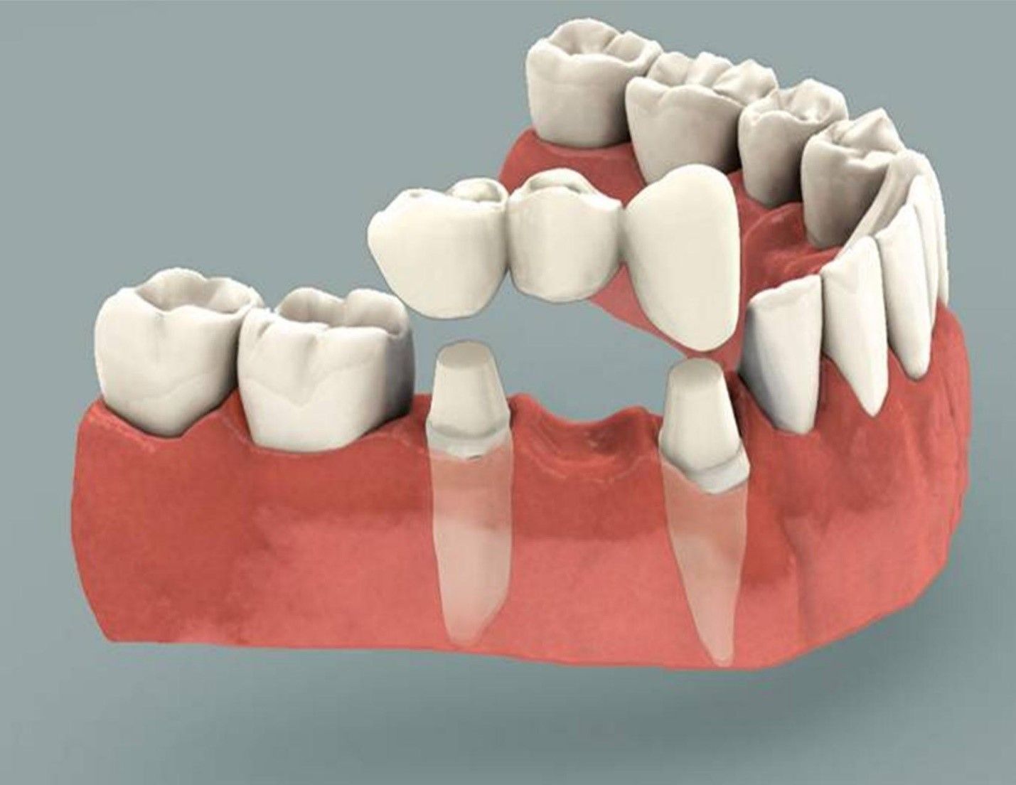 Làm răng giả có ảnh hưởng đến sức khoẻ không?