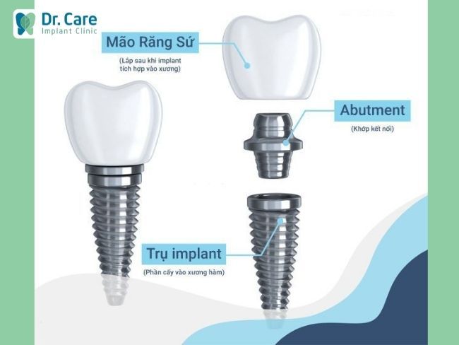 Mão răng sứ trên Implant