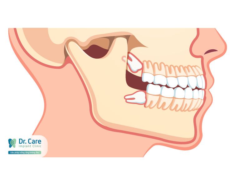 mọc răng khôn có nguy hiểm không