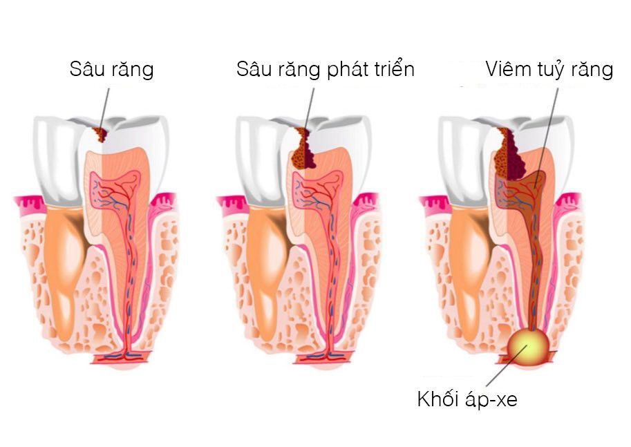 Top 5 nguyên nhân gây đau răng phổ biến hiện nay