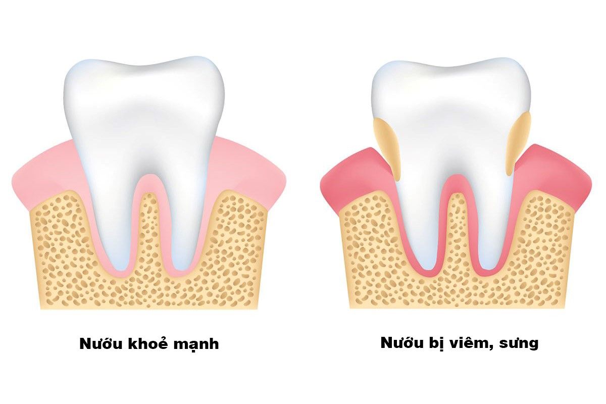 Top 5 nguyên nhân gây đau răng phổ biến hiện nay