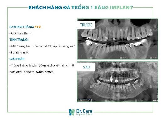 nhổ răng bao lâu thì trồng implant