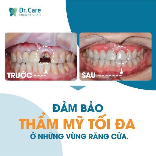 nhổ răng bao lâu thì trồng implant