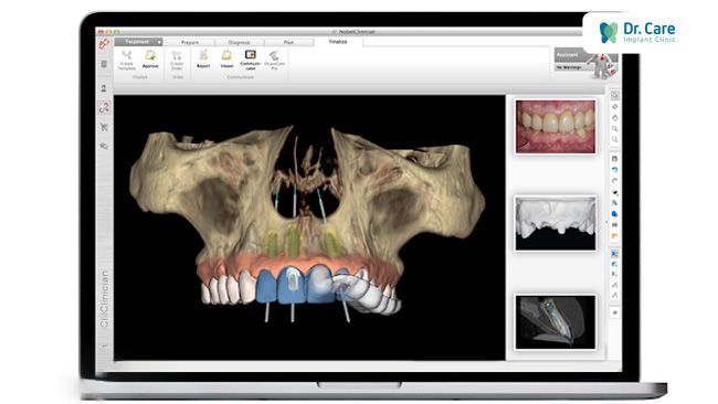 Bác sĩ Dr. Care lập kế hoạch cấy ghép Implant với phần mềm hỗ trợ cấy ghép Implant Nobel Clinician hoặc Implant Studio 