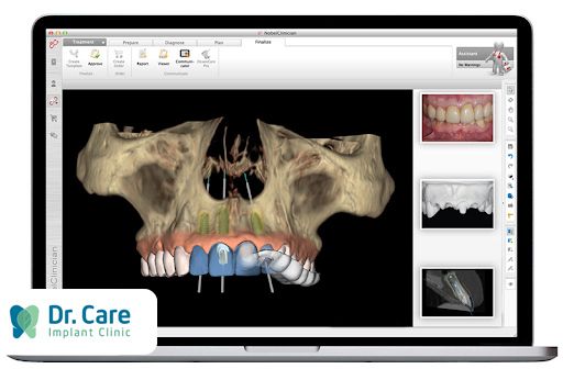 Việc lên kế hoạch đặt implant, răng tạm trên implant trước sẽ giúp cho quá trình đặt implant chính xác và phục hình thẩm mỹ cũng đạt được những yêu cầu mong đợi của khách hàng.