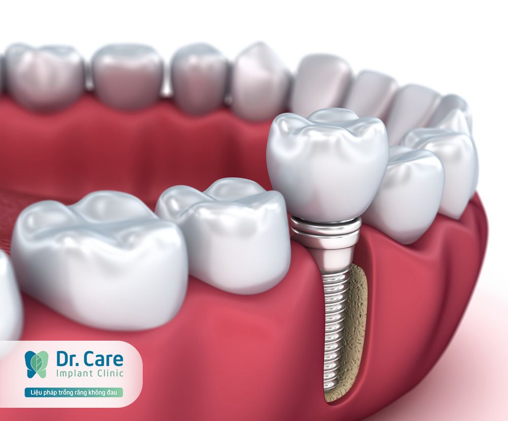 Răng giả bị sâu: Nguyên nhân và cách phục hình răng tốt nhất