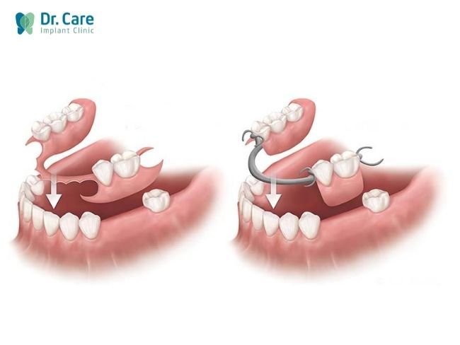 Răng tạm có thể tháo lắp