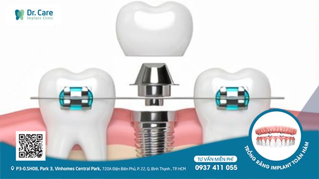 Sau khi trồng răng implant vẫn có thể thực hiện các phương pháp chỉnh nha