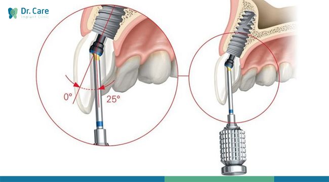 trụ implant nobel biocare