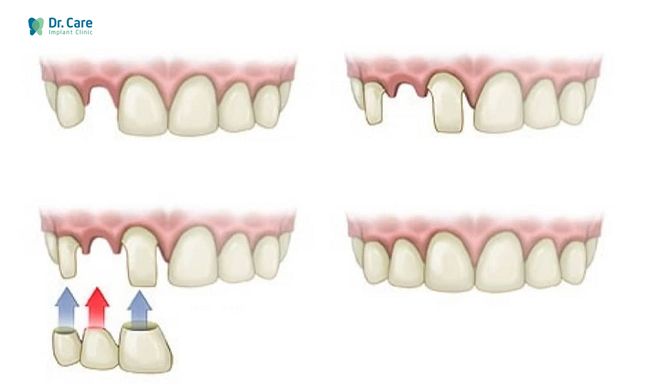 trồng răng cửa