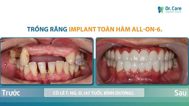 Trồng răng Implant toàn hàm đã được các chuyên gia đánh giá cao, có độ tin cậy đối với người mất răng và công nhận đây là giải pháp lý tưởng nhất để phục hồi lại răng bị mất cho đến thời điểm hiện tại.