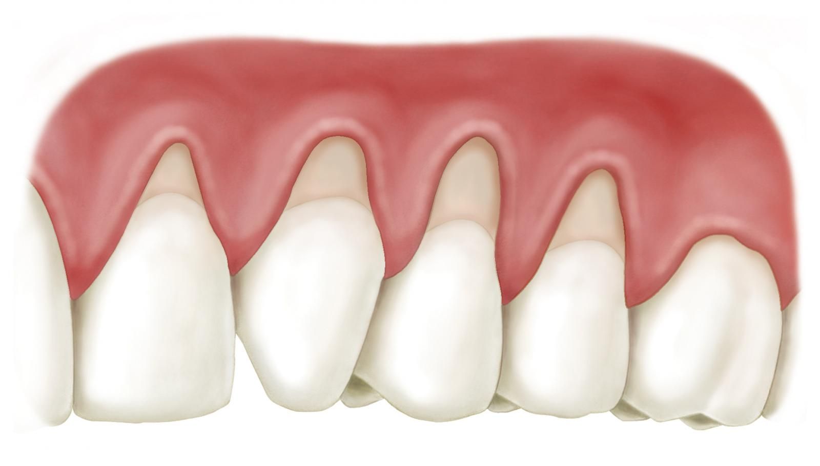 đang có hiện tượng tụt lợi chân răng phải làm sao