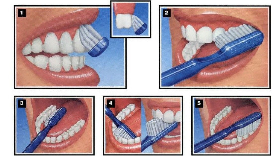 Nguyên nhân gây tụt nướu răng và cách chữa trị hiệu quả