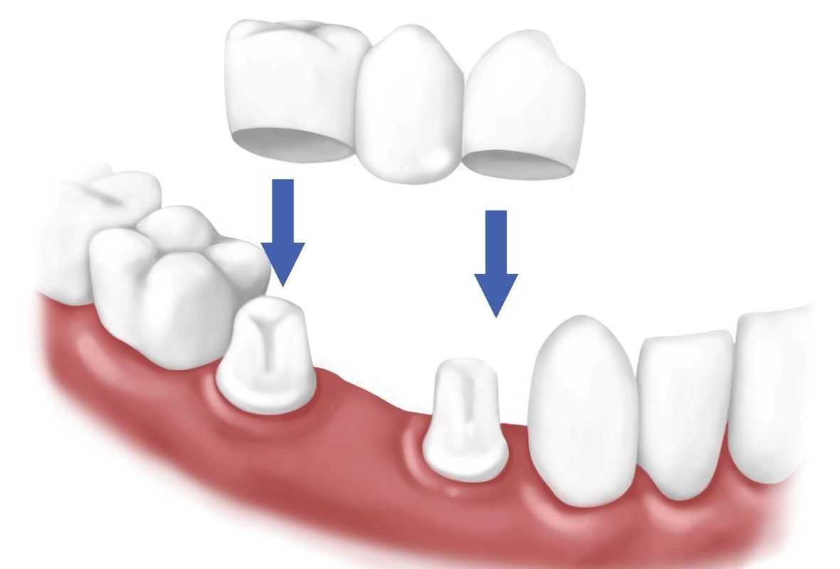 trồng răng sứ van bị ê buốt