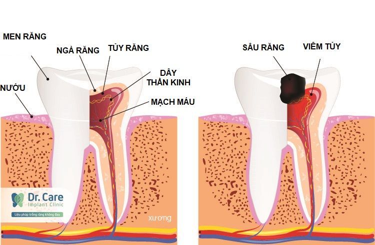 viêm tủy răng