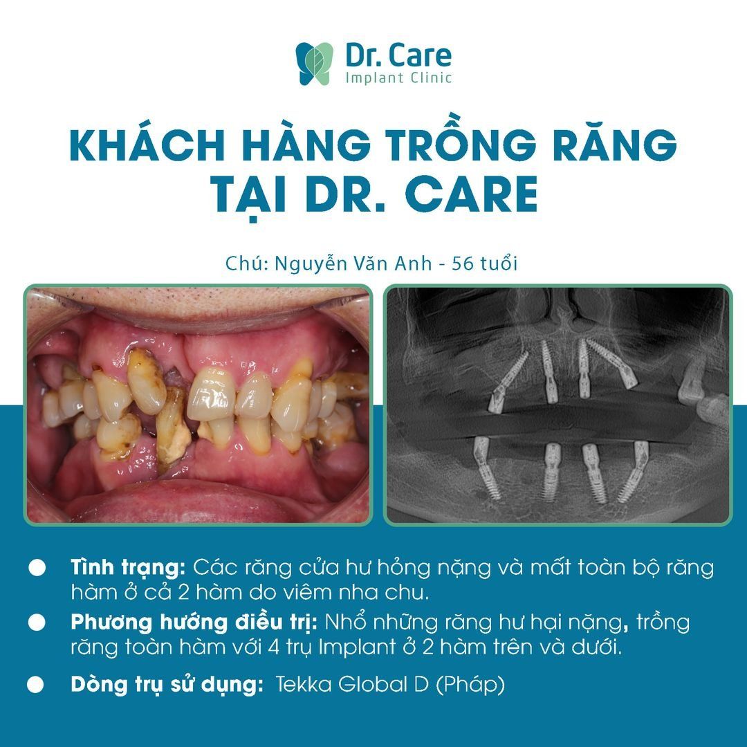 Bắt buộc phải điều trị những bệnh lý răng miệng trước khi tiến hành cấy ghép implant